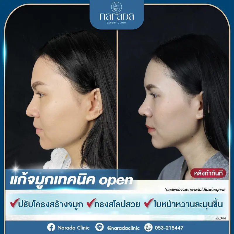 📣มาปรับทรงจมูกให้หวานละมุม เข้ากับใบหน้า