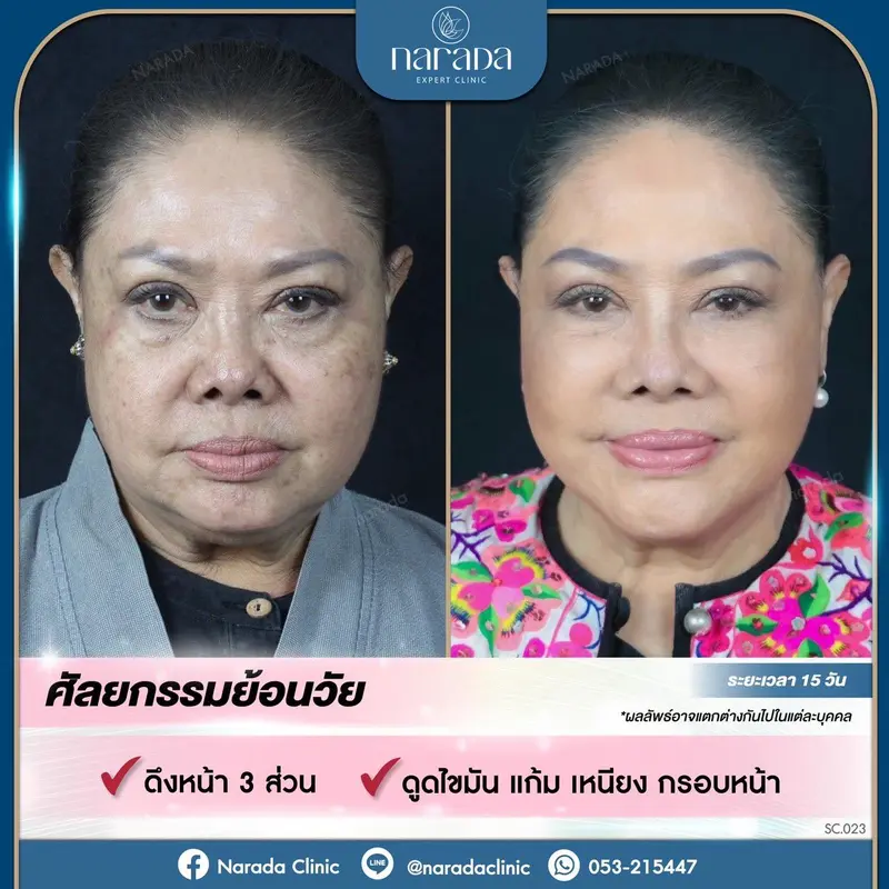 ✨หมดปัญหาใบหน้าหย่อนคล้อย ไม่ตึงกระชับ 