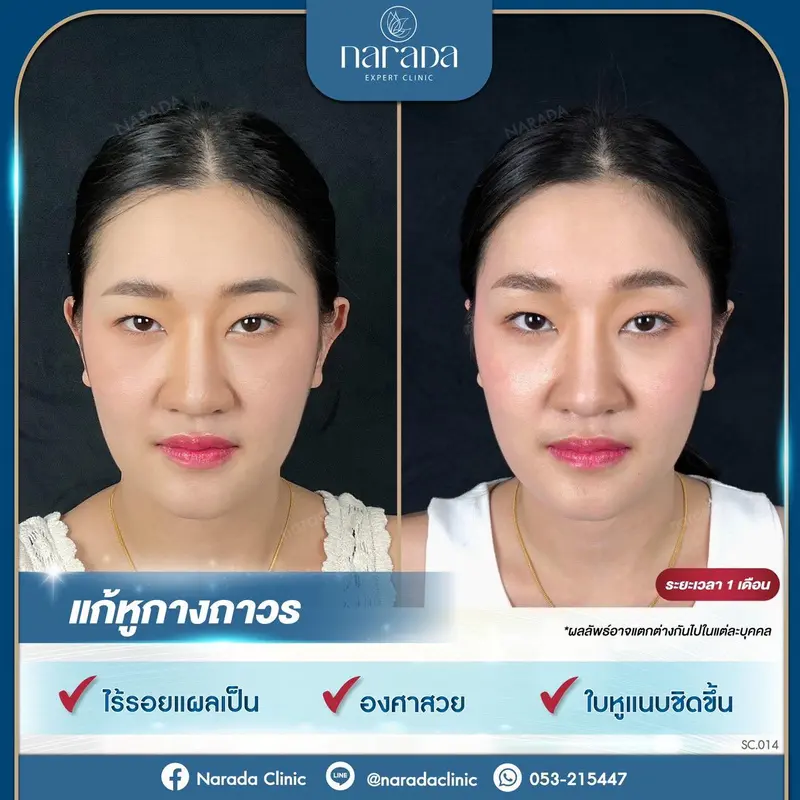 ✨Otoplasty แก้หูกางถาวร ✨