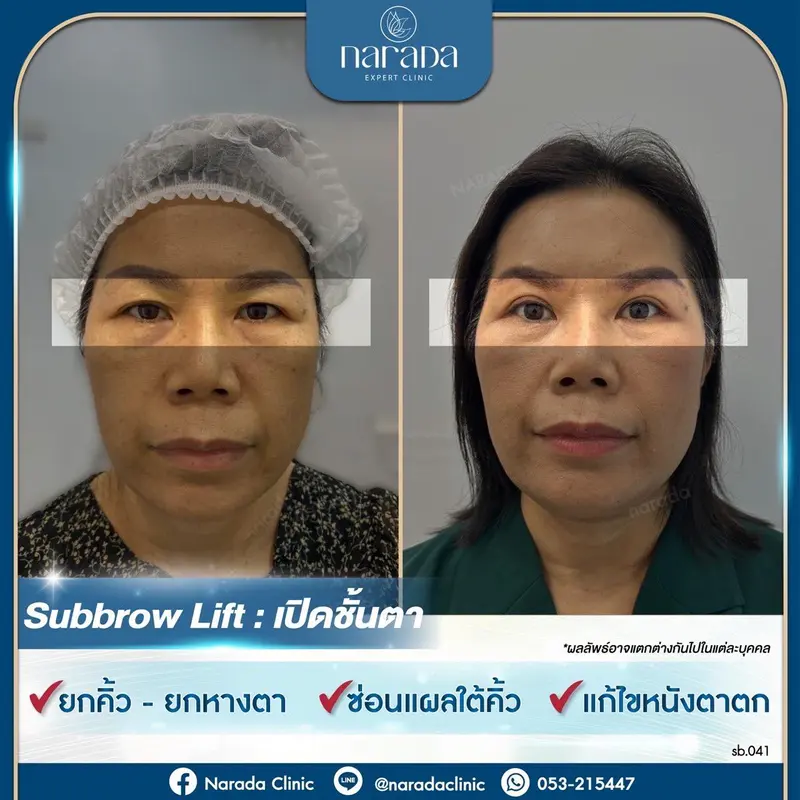 🎀Subbrow Lift ยกคิ้ว ยกชั้นตา