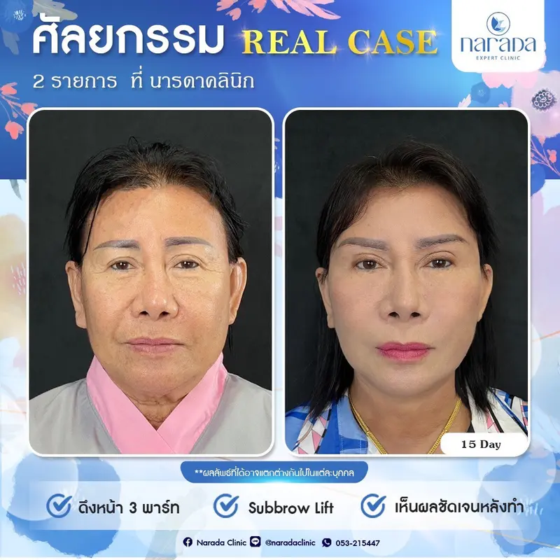 📌 เคสนี้มีปัญหาหนังตาตก คิ้วตก ใบหน้าหย่อนคล้อยผิวบริเวณลำคอหย่อน ร่องแก้มและร่องน้ำหมากลึก 