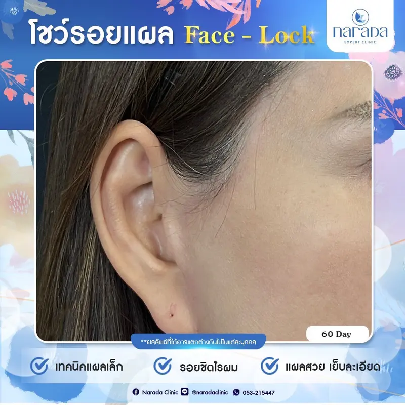 📌📌โชว์รอยแผล Endo-Face Lock หลังจากทำที่นารดาคลินิก ด้วยเทคนิคพิเศษแผลเล็ก รอยแผลชิดไรผม