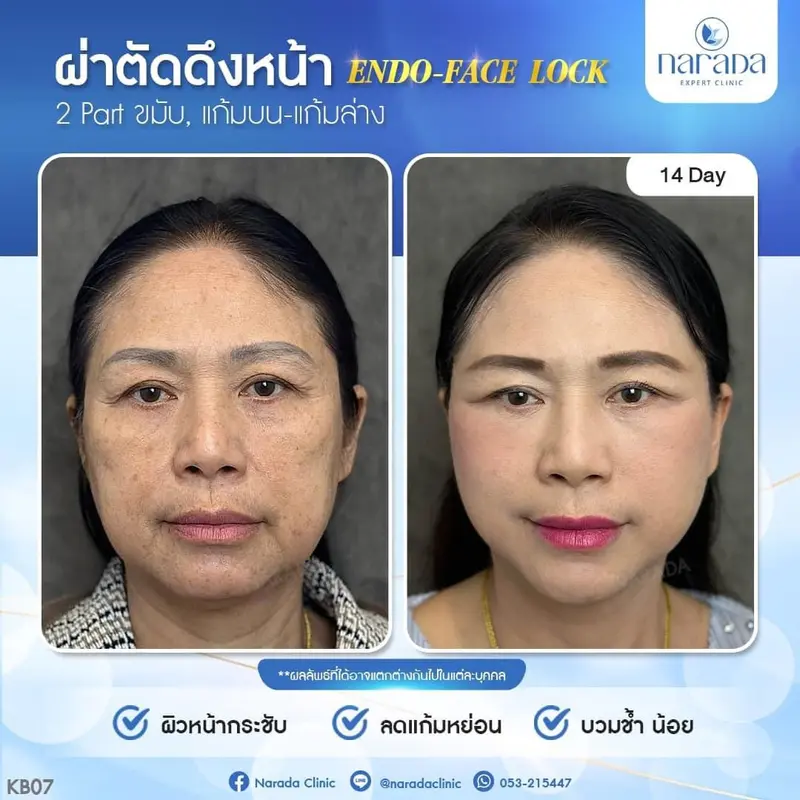 📌 Real Case : เคสนี้มีปัญหาในส่วนของแก้มที่หย่อน