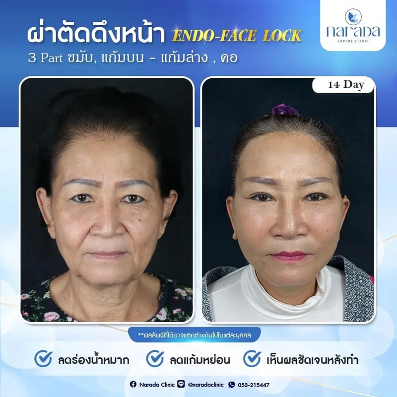 📌 Rael Case : เคสนี้มีปัญหาผิวหนังหย่อนคล้อย 