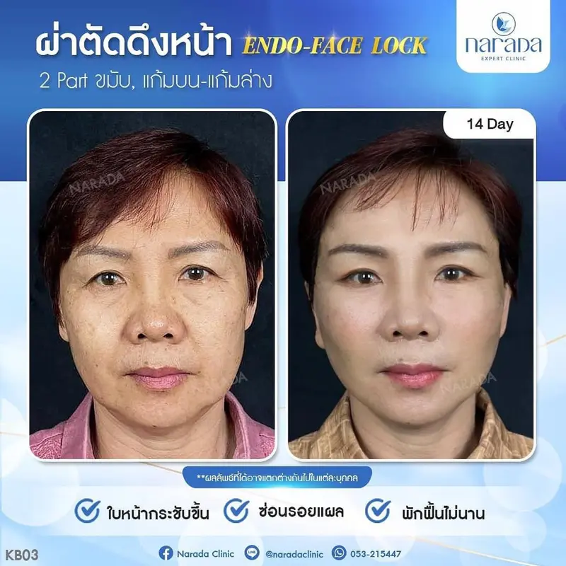 เคสนี้มีปัญหาแก้มหย่อนคล้อยแก้มห้อยร่อยแก้มลึกใต้ตาไม่เรียบเนียนแก้ปัญหาด้วยการดึงหน้าEndo-Face Lock