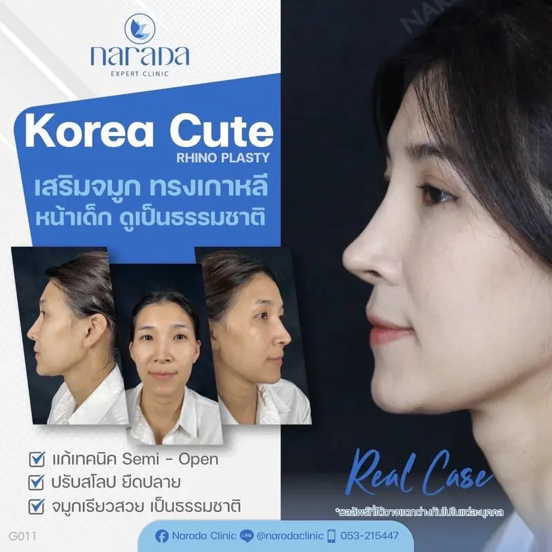  เคสนี้มีปัญหาจมูกเดิมเบี้ยวเอียง สันจมูกดูแข็งทื่อและปลายจมูกบางทำให้ใบหน้าดูมีอายุและไม่หวานละมุน