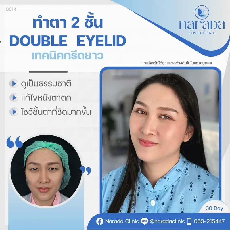 📍Real Case : เคสนี้มีปัญหาตาชั้นเดียว หนังตาตกและดูง่วงนอน 