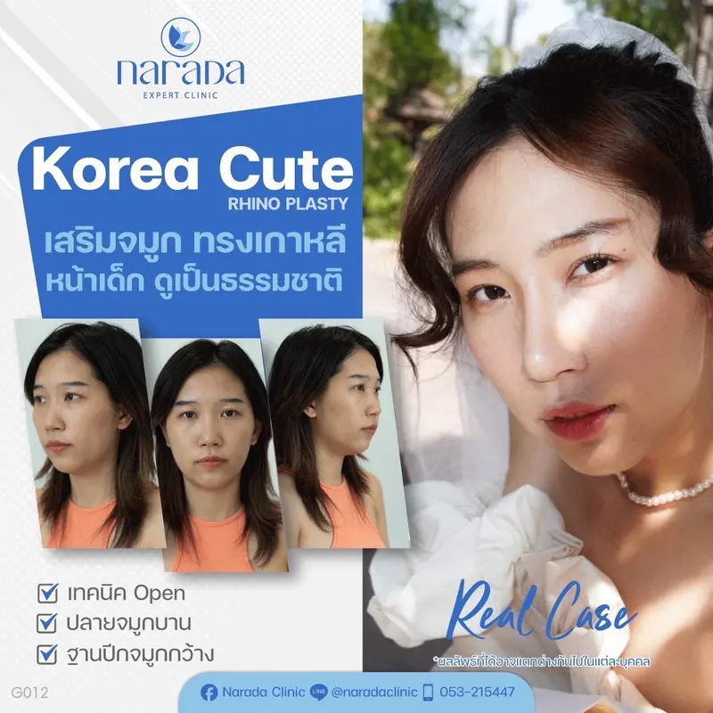เคสนี้มีปัญหาทรงจมูกเดิมมีสันที่ต่ำและเนื้อจมูกตรงปลายเยอะมีปีกจมูกที่ดูกว้างแก้ด้วยเทคนิคKoreaCute 