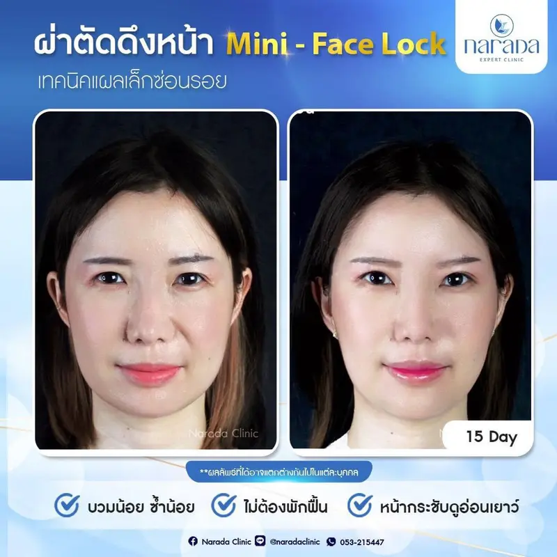 เคสนี้มีปัญหาร่องแก้มและหางตาตกผิวหน้าไม่กระชับแก้ปัญหาใช้เทคนิคผ่าตัดดึงหน้า Mini-Face Lock 1ส่วน 