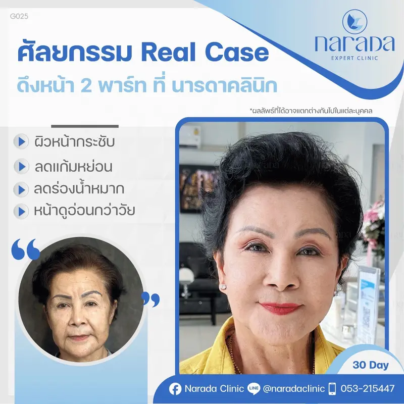 ✨ มาย้อนวัยคืนความสวย และความตึงกระชับลดอายุ ใบหน้าดูอ่อนเยาว์ลง ได้ที่นารดาคลินิกค่ะ 🎉🎉  