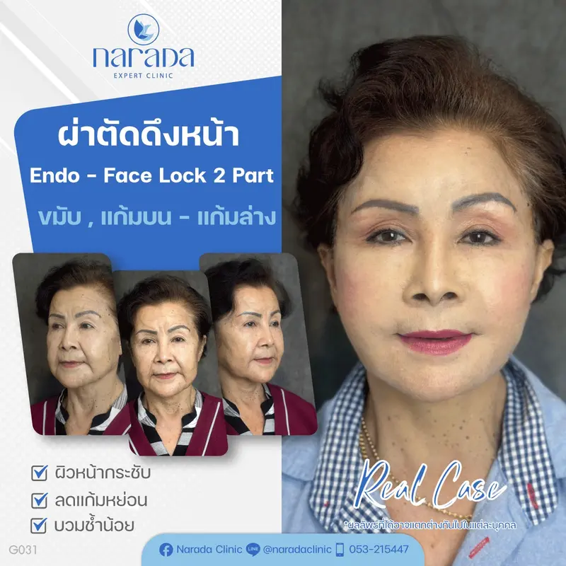 🎉คืนความอ่อนเยาว์อีกครั้งให้กับใบหน้า ด้วยการผ่าตัดดึงหน้าที่นารดาคลินิก