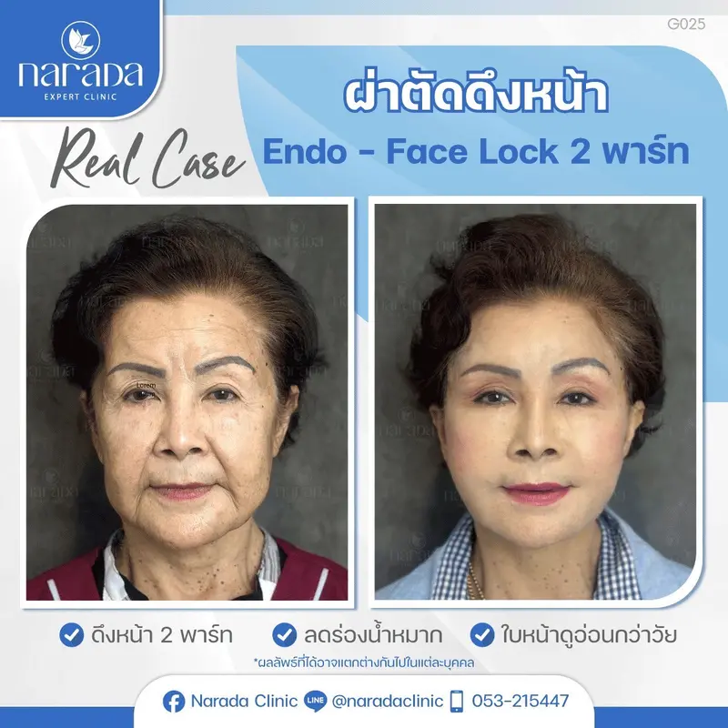 ✨มาย้อนวัยคืนความสวย และความตึงกระชับลดอายุ ได้ที่นารดาคลินิก สวย มั่นใจ 