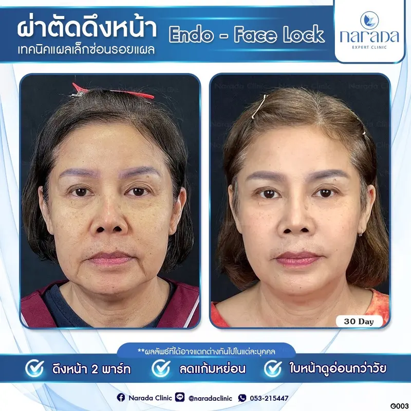 👉🏻Endo-Face Lock ผ่าตัดดึงหน้าลดอายุให้ดูอ่อนกว่าวัย เคสนี้แก้ไขด้วยการดึง 2 พาร์ท 