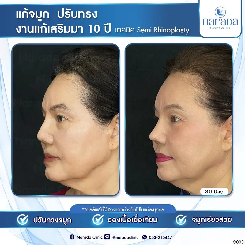 งานแก้เสริมมา 10 ปี เทคนิค Semi Rhinoplasty ปรับทรงจมูกให้เรียวสวยมากขึ้นทำให้ใบหน้าดูหวานละมุน✨