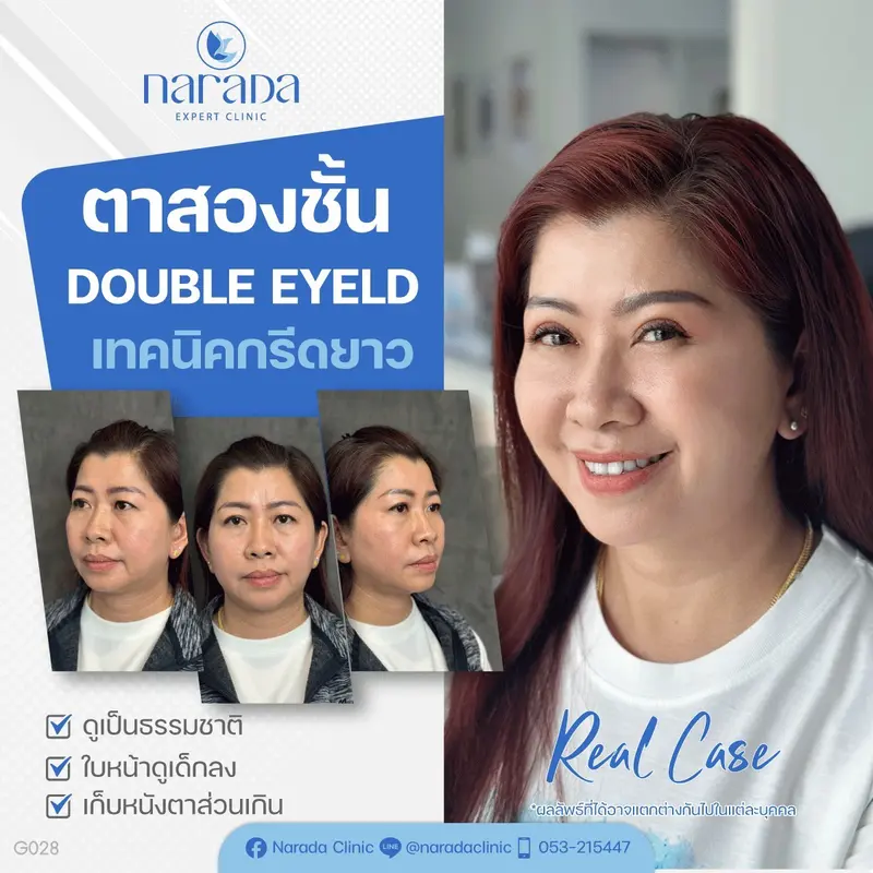 ตาสองชั้น DOUBLE EYELD  แก้ไขปัญหาชั้นตาไม่เท่ากัน หนังตาหย่อนคล้อยชั้นตาไม่ชัด 