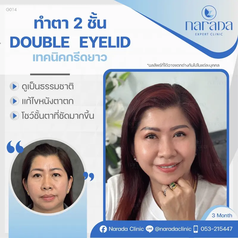 Double Eyelib เทคนิคกรีดยา แก้ไขปัญหาหนังตาตก ชั้นตาหย่อนคล้อยชั้นตาไม่เท่ากัน ที่นารดาคลินิก
