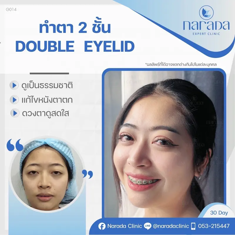 แก้ปัญหาตาชั้นเดียว ชั้นตาหลบใน ไขมันพอกชั้นตาเยอะโดยเทคนิคผ่าตัดตัดหนังตาส่วนเกินออก 