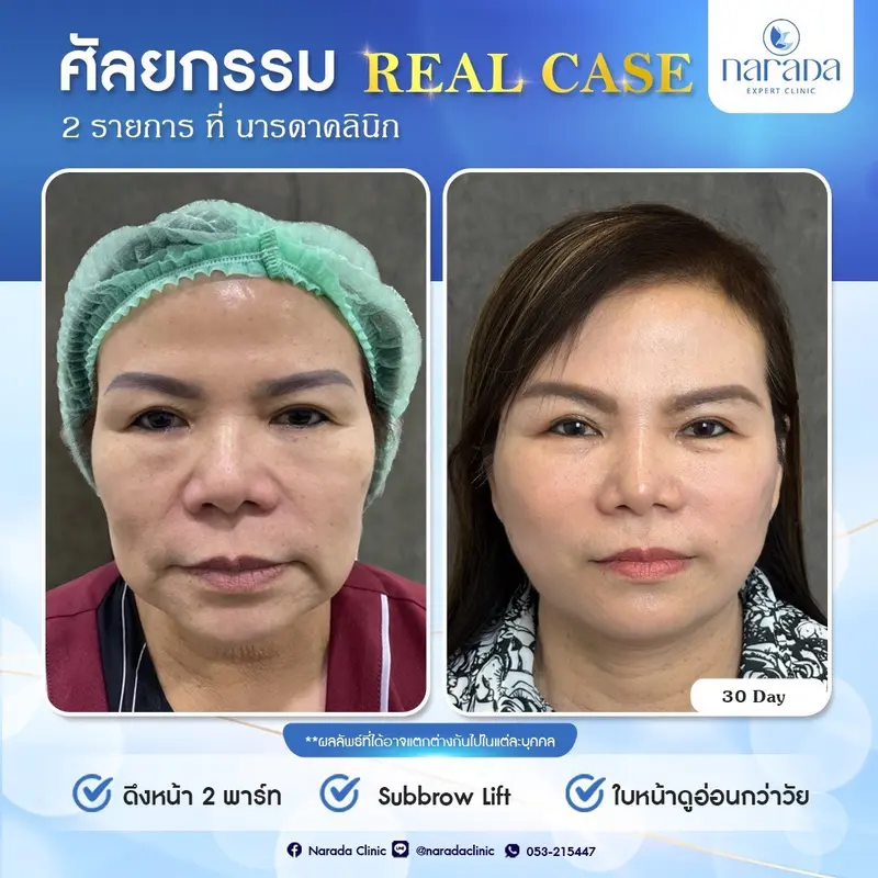 ดึงหน้า 2ส่วน พาร์ทด้านบน  ดึงหน้าแก้มบน-แก้มล่าง,คอ และSubbrow Lift 