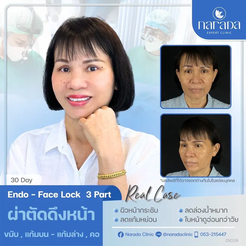 นารดา ยืนหนึ่ง เรื่องดึงหน้า ศูนย์ศัลยกรรมภาคเหนือ 