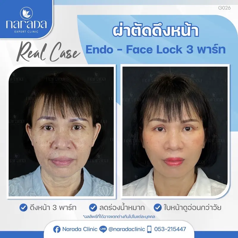 นารดา ยืนหนึ่ง เรื่องดึงหน้า ศูนย์ศัลยกรรมภาคเหนือ