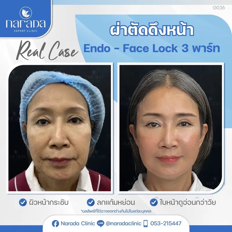 นารดา ยืนหนึ่ง เรื่องดึงหน้า ศูนย์ศัลยกรรมภาคเหนือ