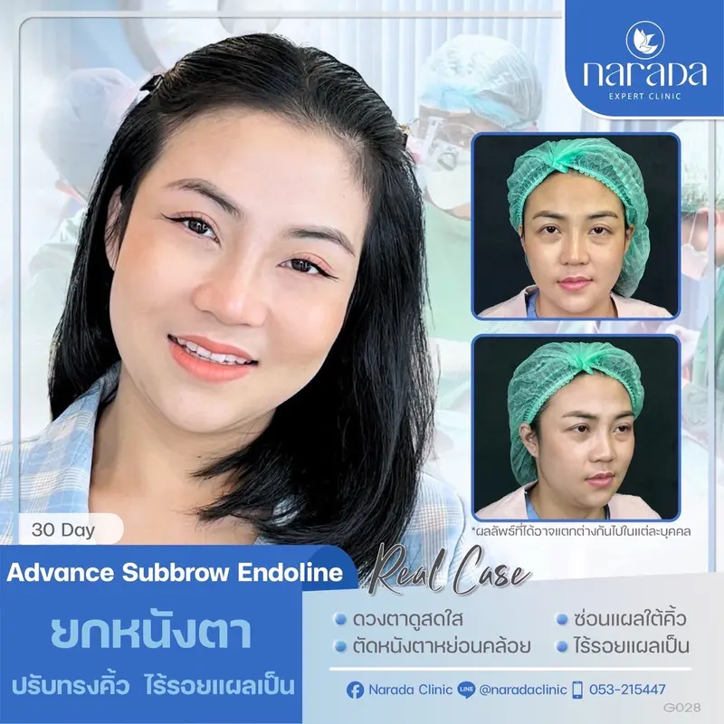 📌 Real Case: เคสนี้มีปัญหา หางตาตก หางคิ้วตก ทำให้ชั้นตาดูไม่เท่ากัน