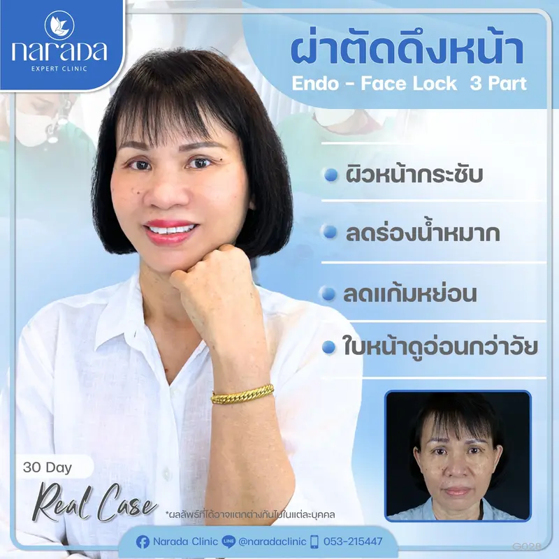 นารดา ยืนหนึ่ง เรื่องดึงหน้า ศูนย์ศัลยกรรมภาคเหนือ