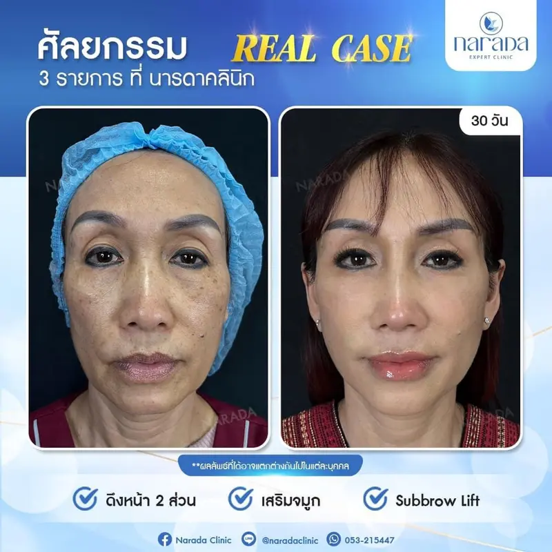 📌 Real Case : ลูกค้าเคสนี้มีปัญหาผิวหน้าหย่อนคล้อย เบ้าตาลึกทำให้ดวงตาดูไม่สดใสและหางตาตกดูมีอายุ