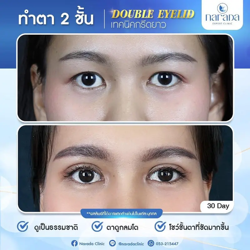 📌 Real Case : ลูกค้ามีปัญหา ชั้นตาหลบใน ชั้นตา ไม่เท่ากัน 