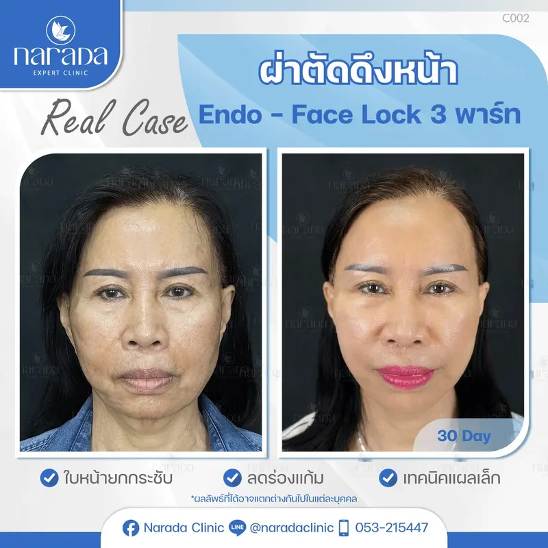 ✨ศัลยกรรมย้อนวัย ด้วยการผ่าตัดดึงหน้า Endo - Face Lock ที่นารดาคลินิก