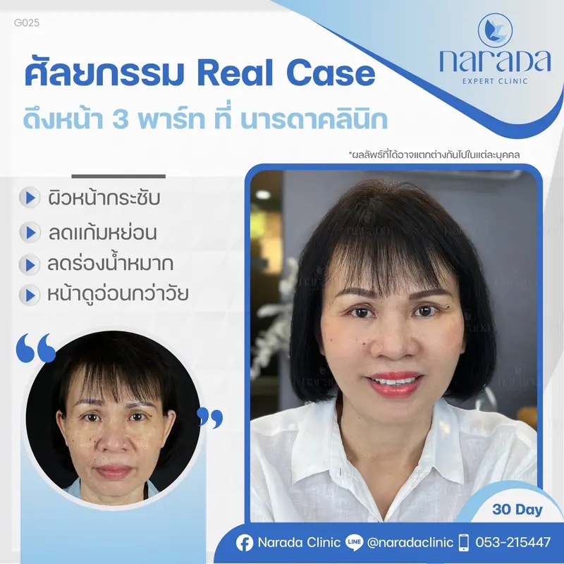 🎉 ลดความหย่อนคล้อยบนใบหน้า ให้ย้อนวัยลง 10 ปี ที่ นารดาคลินิกค่ะ