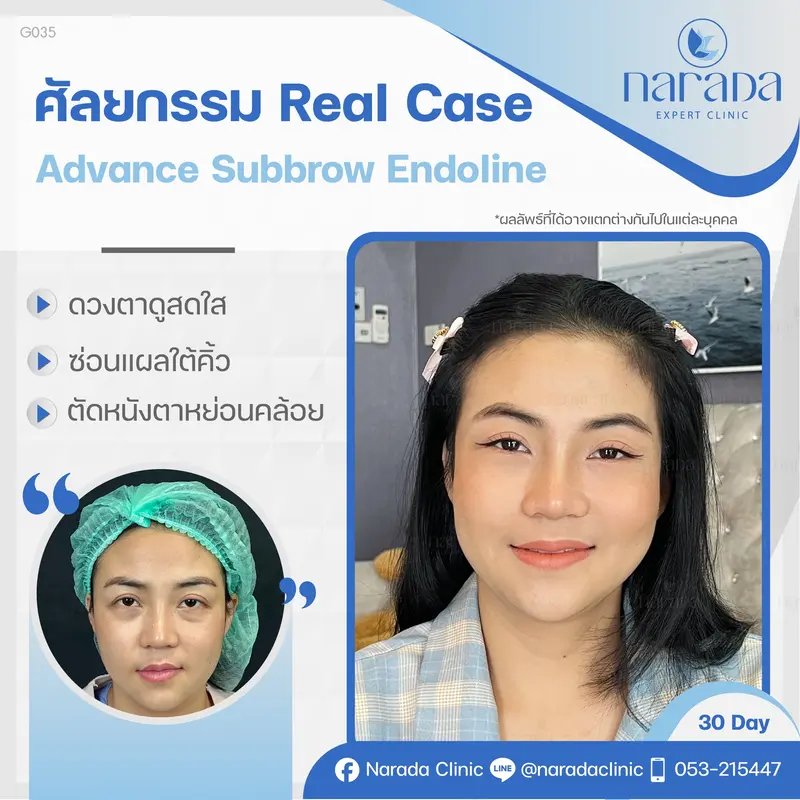 Advance Subbrow Endoline ยกหนังตา ปรับทรงคิ้ว ไร้รอยแผลเป็น ที่ นารดาคลินิก ✨