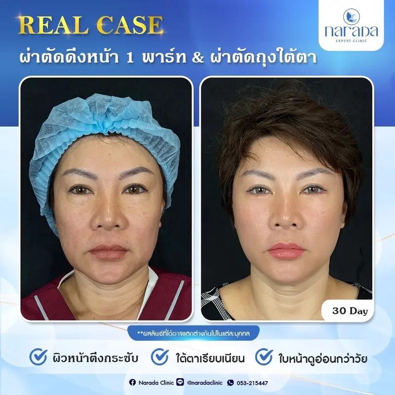 📌 Real Case: เคสนี้มีความกังวลเรื่องแก้มย้อยและมีถุงใต้ตา 