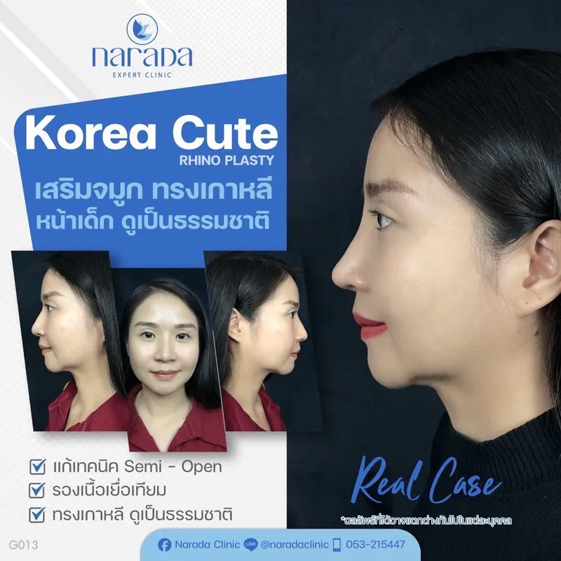 📍Real Case : เคสนี้มีปัญหาทรงจมูกเดิมแข็งทื่อปลายจมูกบาง และทรงดูงุ้มไม่เป็นธรรมชาติทำให้ใบหน้าดู