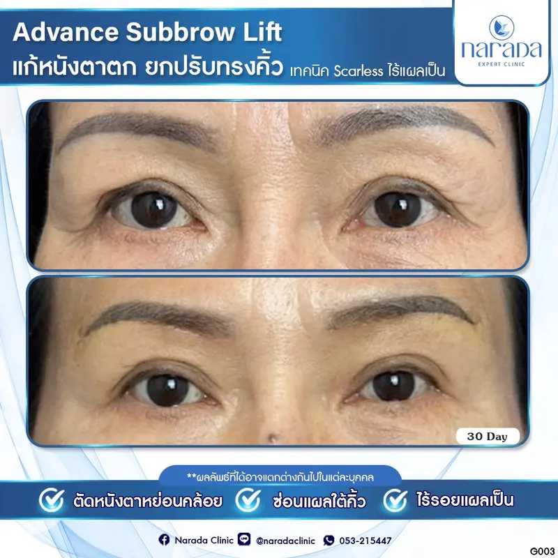 📌 Real Case: เคสนี้มีปัญหาหนังตาตกทำให้ชั้นตาไม่ชัด หางคิ้วและหางตาตกลงทำให้ดวงตาดูมีอายุ