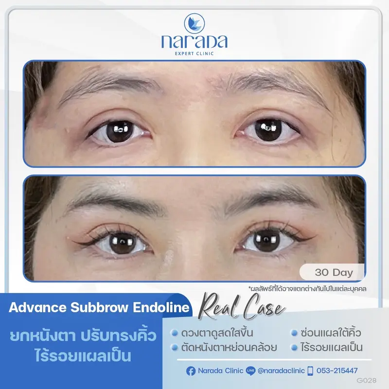 ✨ เปิดชั้นตา ยกหนังตา ปรับทรงคิ้ว ที่หย่อยคล้อย ด้วยการทำ Advance Subbrow Endoline 
