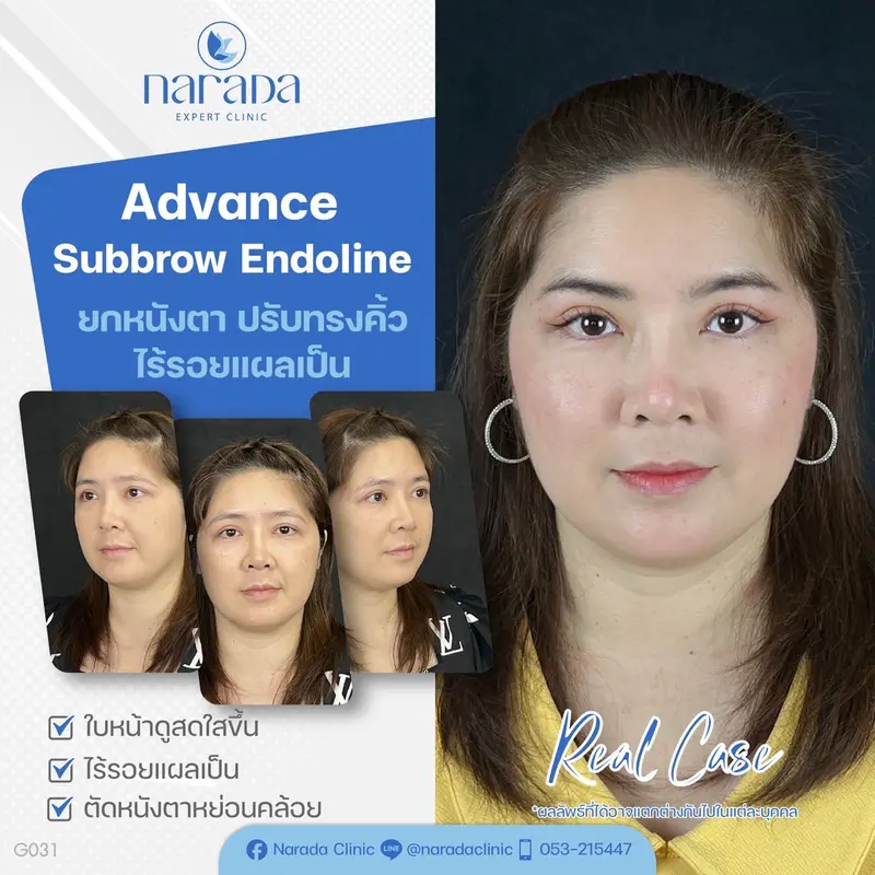 ✨ บอกลาปัญหาหนังตาหย่อนคล้อย คิ้วตก หางตาตก และปรับทรงคิ้วให้ยกขึ้น อย่างเป็นธรรมชาติ 