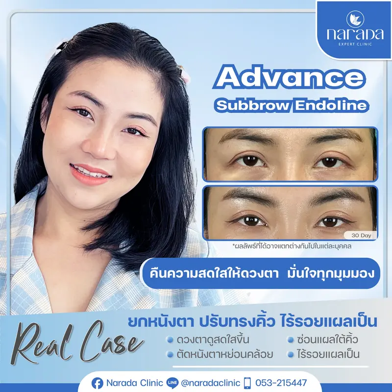 ✨คืนความสดใสให้กับดวงตา บอกลาปัญหาหนังตาหย่อยคล้อย และปรับทรงคิ้วให้ยกขึ้น อย่างเป็นธรรมชาติ 