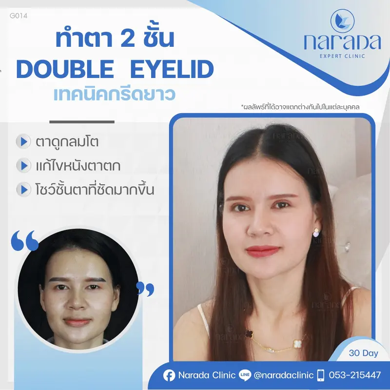 📌 Real Case: เคสนี้มีปัญหาหนังตาตก จึงทำให้ชั้นตาหลบในและดูว่าชั้นตาไม่เท่ากัน 