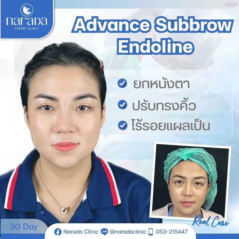 หมดปัญหาหางตาและหางคิ้วตก ทำให้ดวงตาดูไม่สดใส แก้ไขด้วย Advance Subbrow Endoline ที่นารดาคลินิก✨