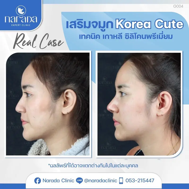 จมูกสวยด้วยเทคนิคไร้สิริโคน Korea Cute Semi-open +รองปลายเนื้อเยื่อเทียม
