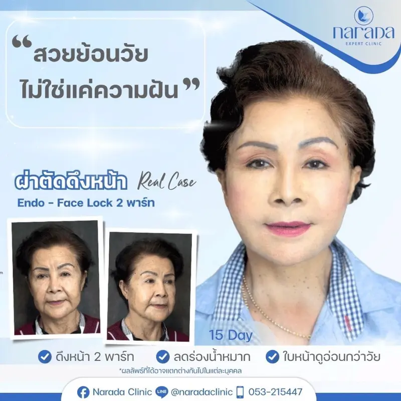 ✨ สวยย้อนวัย ไม่ใช่แค่ความฝัน ด้วยการผ่าตัดดึงหน้า Endo-Face Lock ที่นารดาคลินิก✨