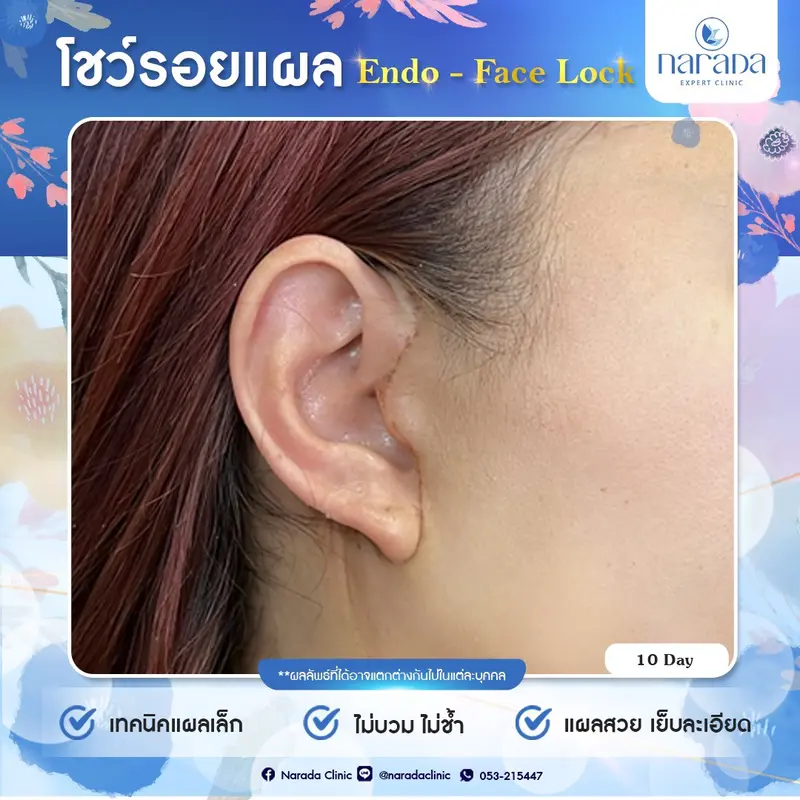 👉🏻 วันนี้พามาชมรอยแผล หลังทำผ่าตัดดึงหน้า Endo-Face Lock เทคนิคแผลเล็กที่นารดาคลินิก