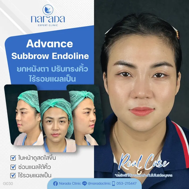 ✨ บอกลาปัญหาหนังตาตก คิ้วตก และหนังตาที่หย่อนคล้อยโดยใช้เทคนิค Advance Subbrow Endoline 