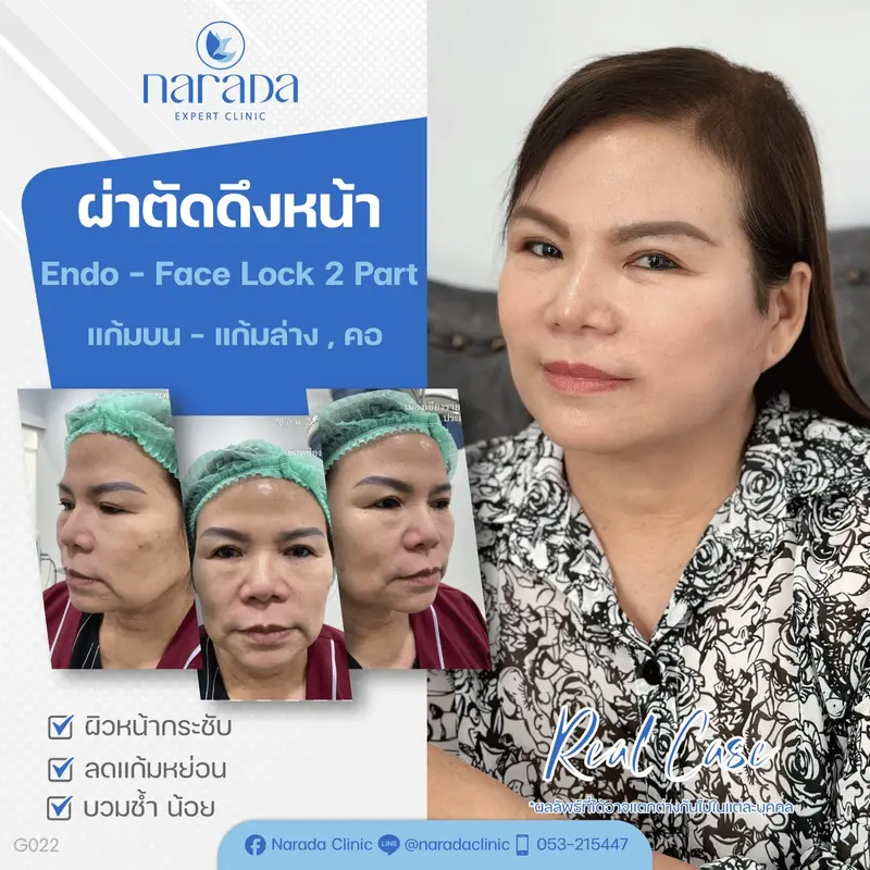 📍Real Case :เคสนี้มีปัญหาใบหน้าหย่อนคล้อยไม่กระชับ ร่องแก้มและริ้วรอยเห็นชัด