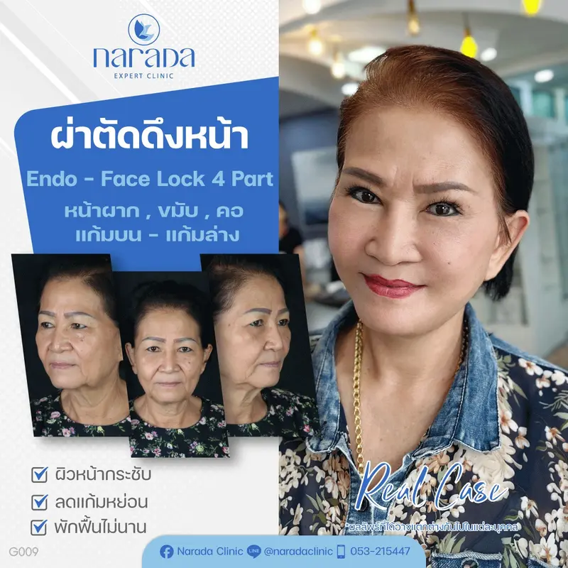 📌 Rael Case: เคสนี้มีปัญหาแก้มหย่อน แก้มย้วย ร่องน้ำหมากเยอะ และหางตาดูตกได้แก้ไขปัญหา