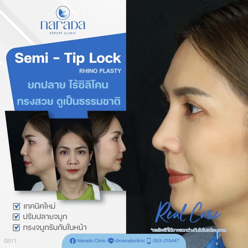 📌 Rael Case: เคสนี้มีปัญหาปลายจมูกงุ้มตกลง และทรงจมูกตรงไม่สโลปทำให้ใบหน้าดูดุไม่หวามละมุม