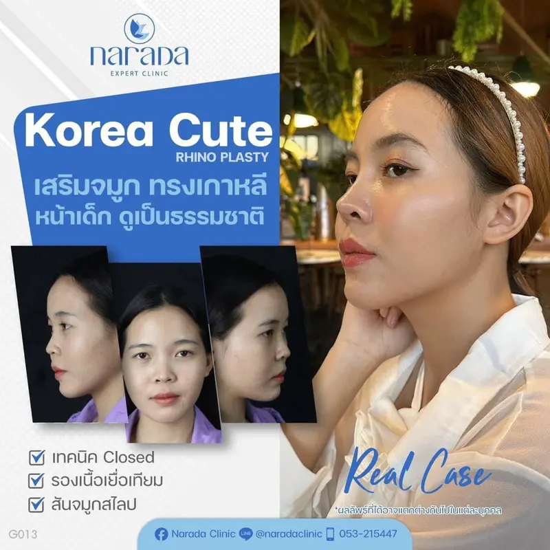 📍Real Case : เคสนี้มีปัญหาเนื้อจมูกน้อยและปลาย จมูกบางทำให้ใบหน้าดูไม่มีมิติและหน้าดูดุ