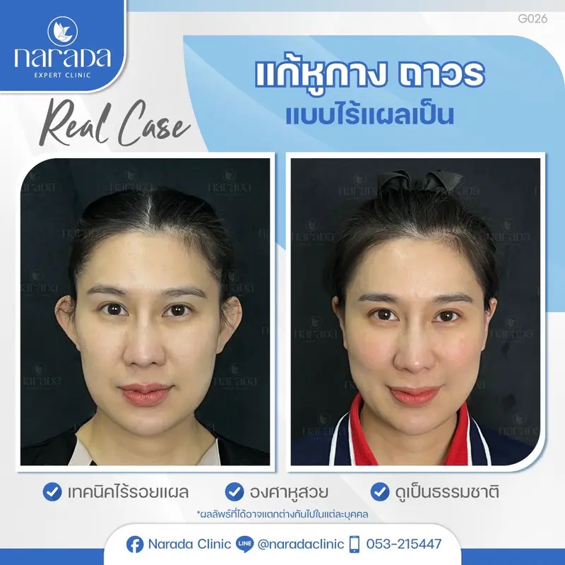 📌 Rael Case: เคสนี้มีปัญหาใบหูกาง และใบหูทั้งสองข้างค่อนข้างใหญ่ ทำให้องศาของใบหูดูไม่รับกับใบหน้า