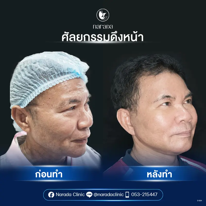 📍Real Case : เคสย้อนวัย ด้วยการผ่าตัดดึงหน้า Endo - Face Lock